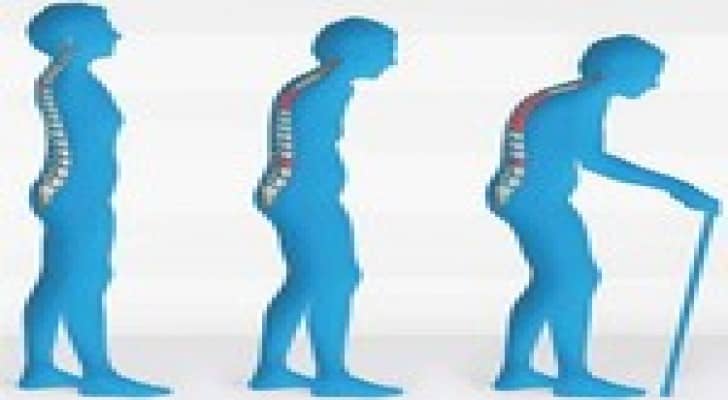 الإكزيما مرتبطة بالكسور الناجمة عن هشاشة العظام