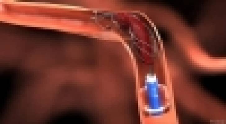 اصطياد الجلطة... طريقة مبتكرة لعلاج السكتة الدماغية