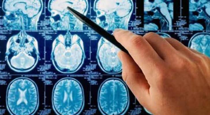 دواء جديد لعلاج سرطان الرأس والعنق أكثر فعالية من الكيماوي