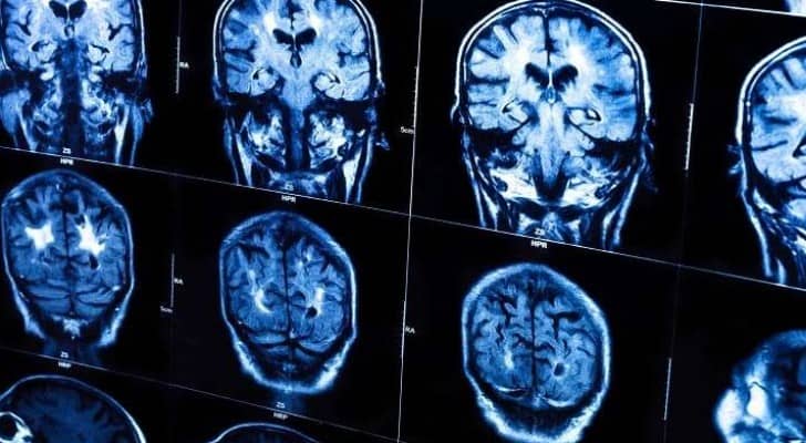 الذكاء والنجاح يجعلك أكثر عرضة لسرطان الدماغ!