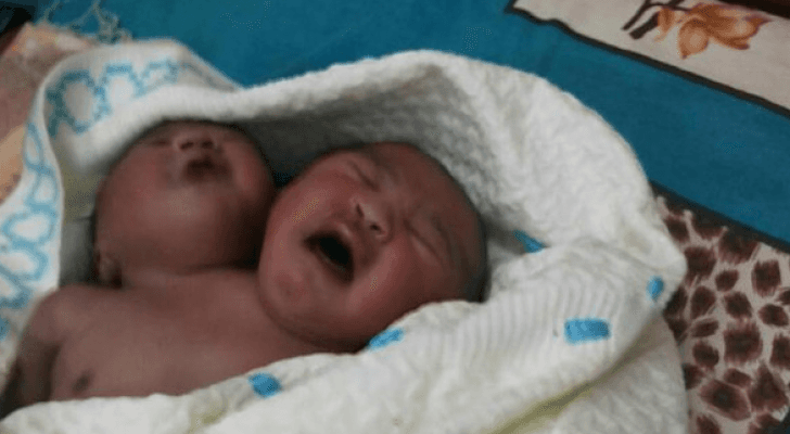 ولادة طفل برأسين في السودان