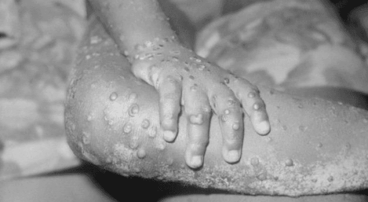 شخص مصاب بمرض جدري القردة