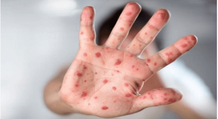الطراونة: فترة العلاج من جدري القردة تصل إلى 4 أسابيع