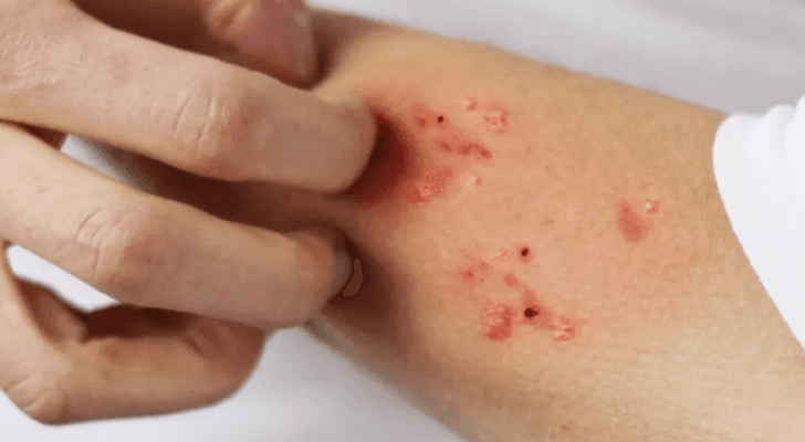 شخص مصاب بالجرب "تعبيرية"