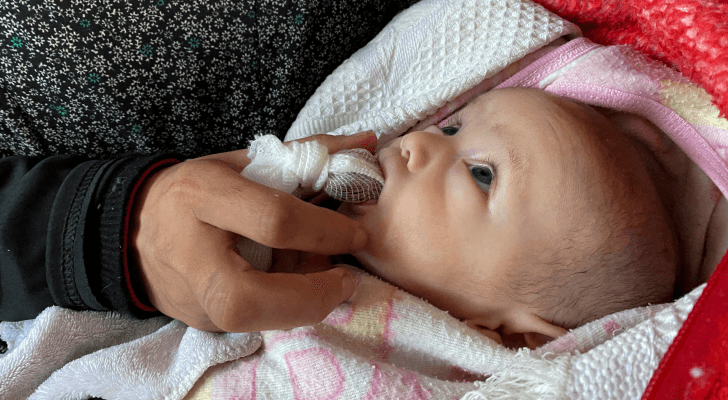 طفل في غزة يعاني سوء التغذية