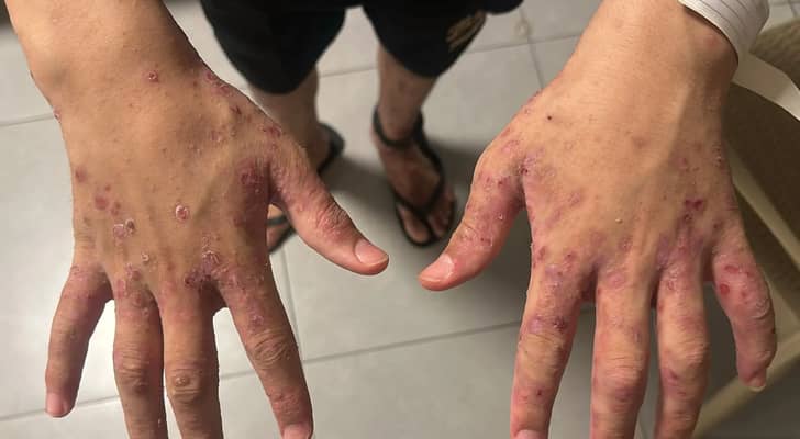 "شؤون الأسرى ونادي الأسير": الاحتلال يستخدم مرض الجرب كأسلوب لتعذيب الأسرى