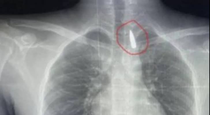 صورة أشعة توضح أين استقر المقذوف الناري