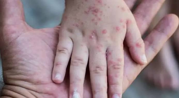 الجدري المائي